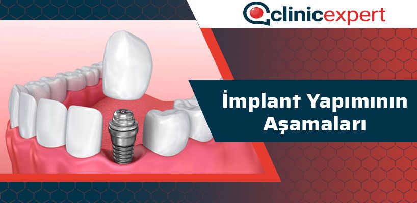 implant-yapiminin-asamalari-cln