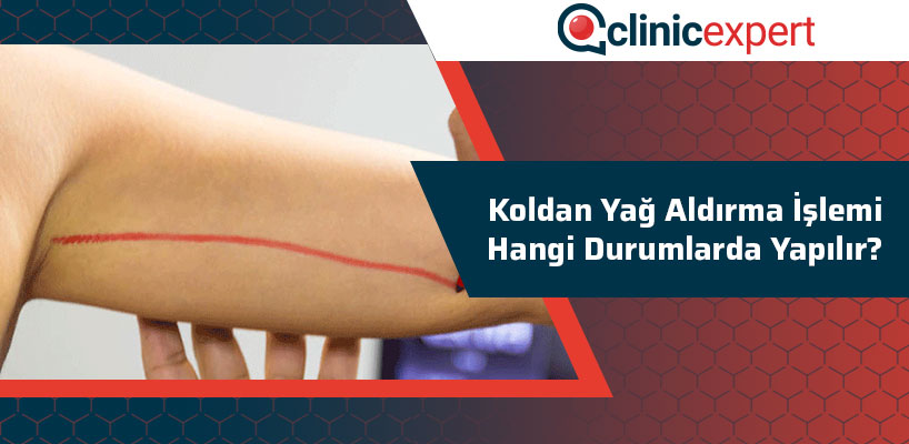 Koldan Yağ Aldırma İşlemi Hangi Durumlarda Yapılır?