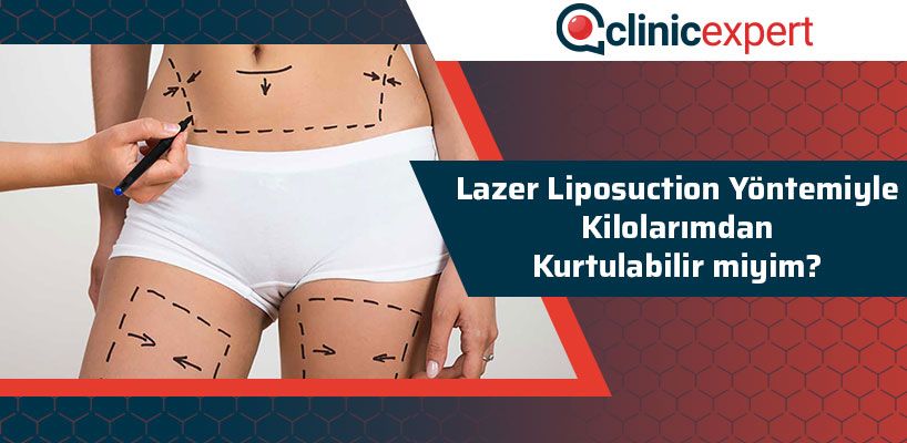 lazer-liposuction-yontemiyle-kilolarçmdan-kurtulabilir-miyim-cln