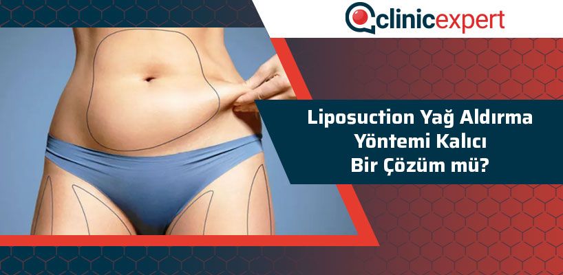 liposuction-yag-aldirma-yontemi-kalici-bir-cozum-mu-cln