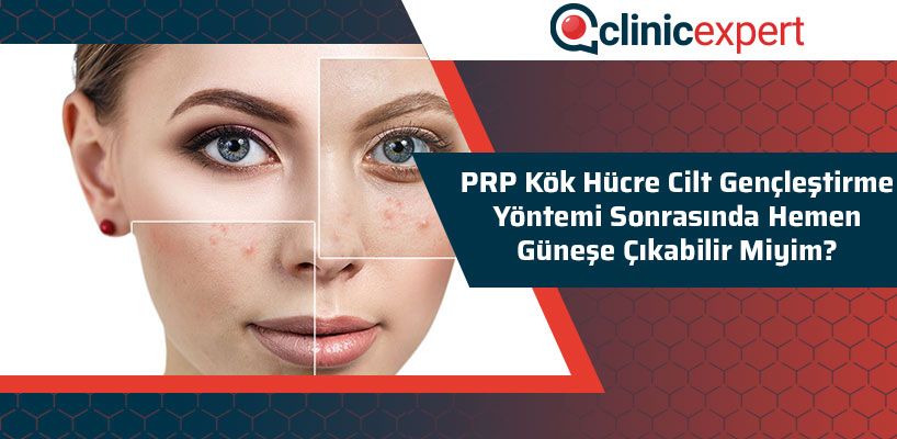 prp-kok-hucre-cilt-genclestirme-yontemi-sonrasinda-hemen-gunese-cikabilir-miyim-cln