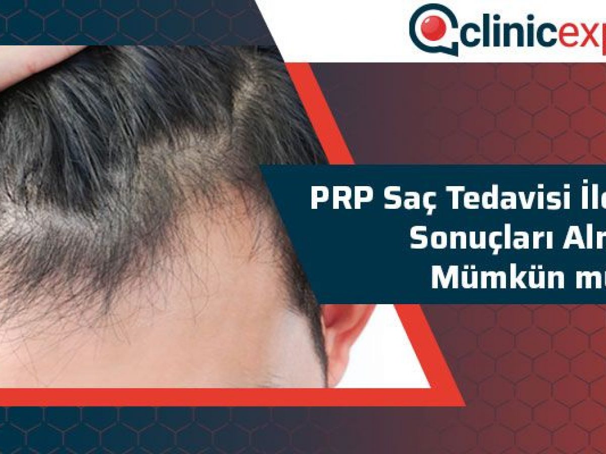 Prp Sac Tedavisi Ile Istenilen Sonuclari Almak Mumkun Mu Clinicexpert