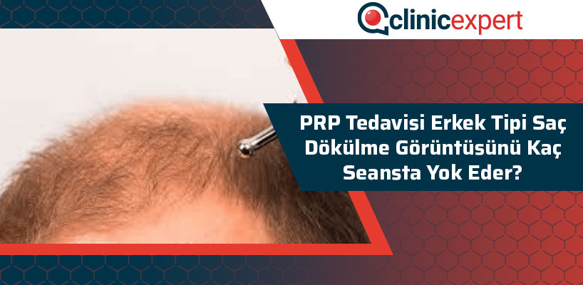 Prp Tedavisi Erkek Tipi Saç Dökülme Görüntüsünü Kaç Seansta Yok Eder?