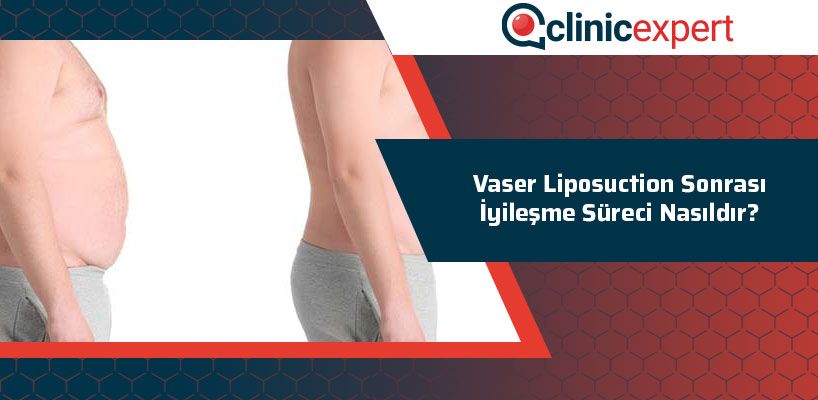 vaser-liposuction-sonrasi-iyilesme-sureci-nasildir-cln