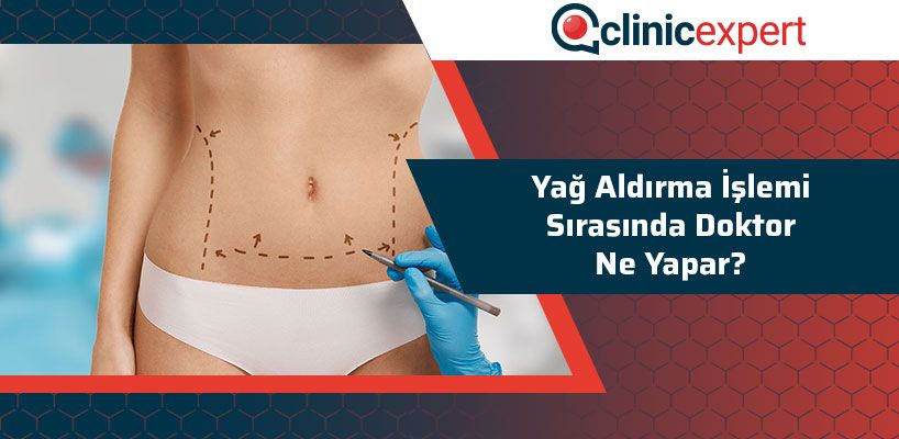 Yağ Aldırma İşlemi Sırasında Doktor Ne Yapar?