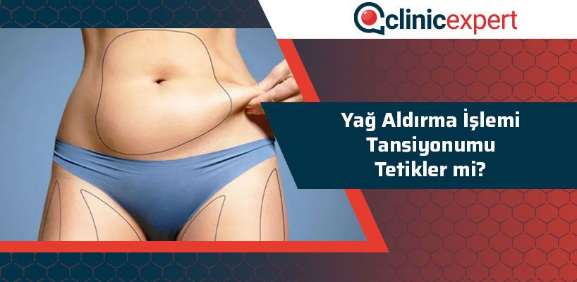 Yağ Aldırma İşlemi Tansiyonumu Tetikler Mi?