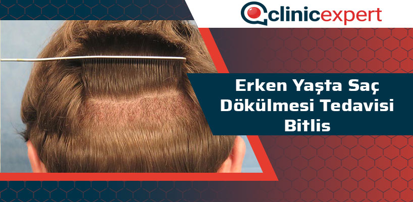 Erken Yaşta Saç Dökülmesi Tedavisi Bitlis