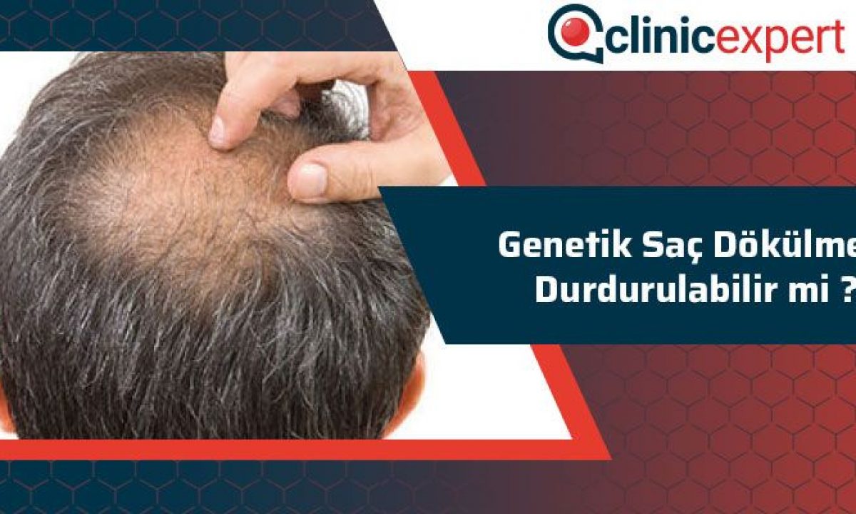 Genetik Sac Dokulmesi Durdurulabilir Mi Clinicexpert Com
