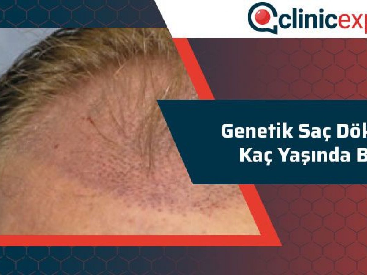 Genetik Sac Dokulmesi Kac Yasinda Baslar Clinicexpert Com Genetik Sac Dokulmesi Kac Yasinda Baslar Clinicexpert Com
