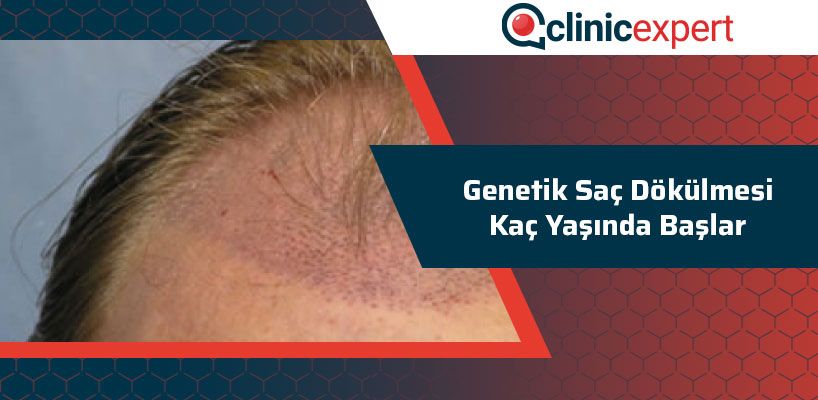 Genetik Sac Dokulmesi Kac Yasinda Baslar Clinicexpert Com