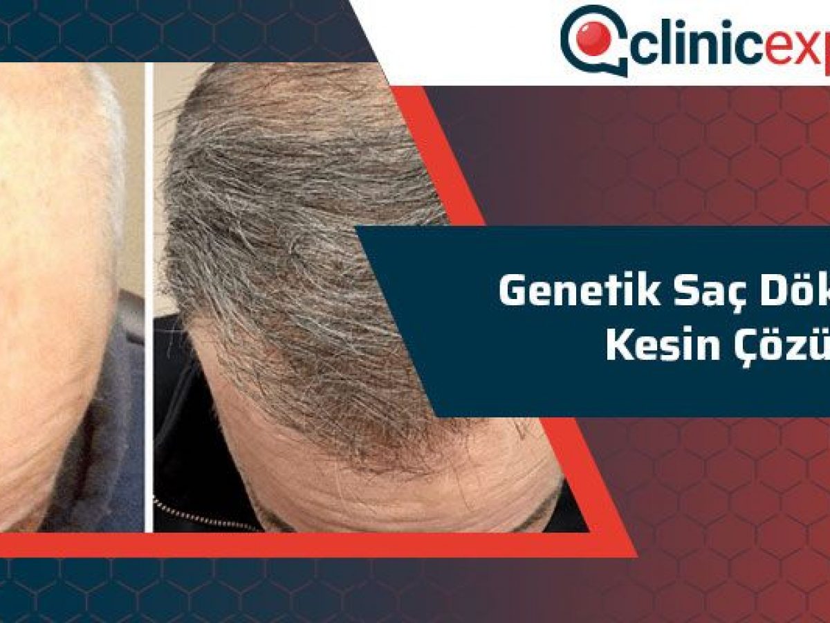 Genetik Sac Dokulmesi Kesin Cozum