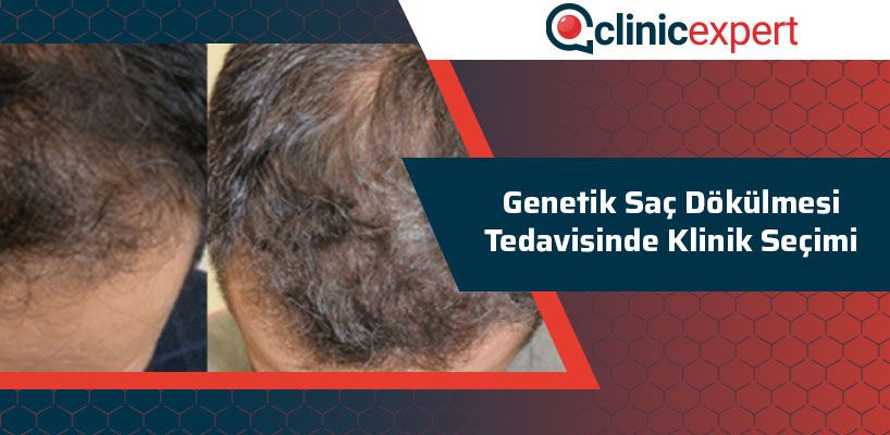 Genetik Saç Dökülmesi Tedavisinde Klinik Seçim