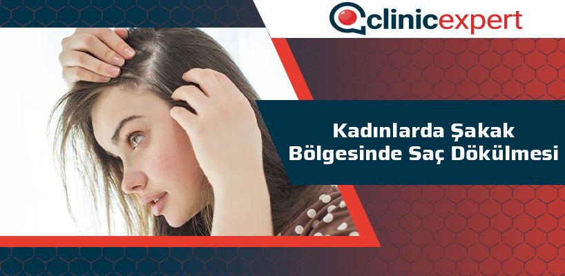 Kadınlarda Şakak Bölgesinde Saç Dökülmesi