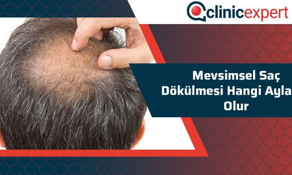 Mevsimsel Sac Dokulmesi Hangi Aylarda Olur Mevsimsel Sac Dokulmesi Hangi Aylarda Olur