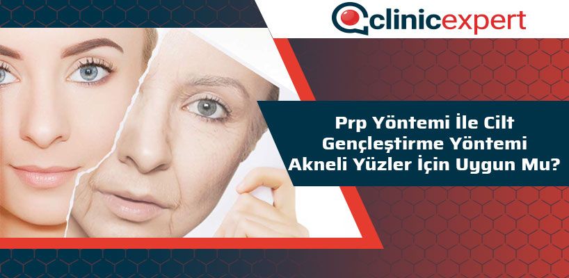PRP Yöntemi ile Cilt Gençleştirme Yöntemi Akneli Yüzler İçin Uygun Mu?