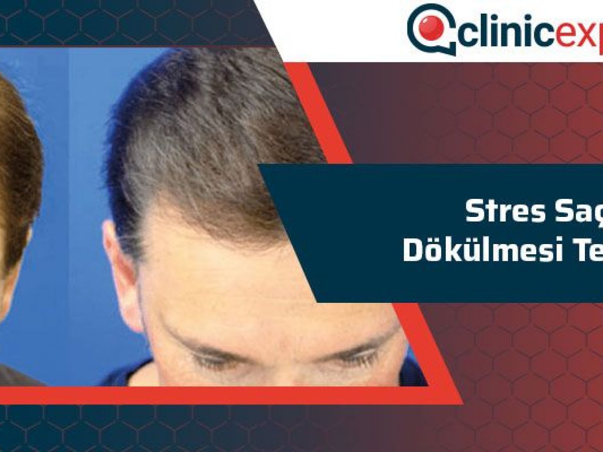 Stres Sac Dokulmesi Tedavi Clinicexpert Sac Ekim Merkezi