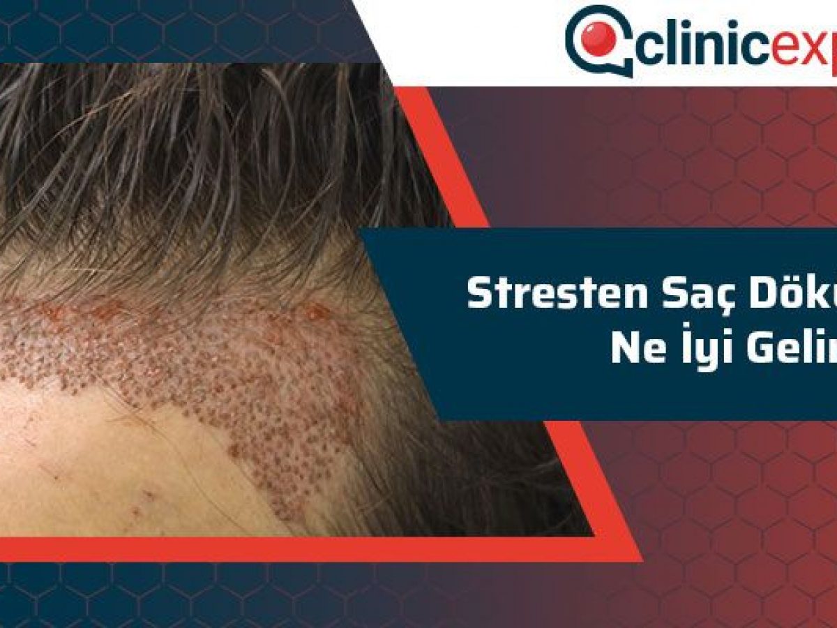 Stresten Sac Dokulmesine Ne Iyi Gelir Clinicexpert Stresten Sac Dokulmesine Ne Iyi Gelir Clinicexpert