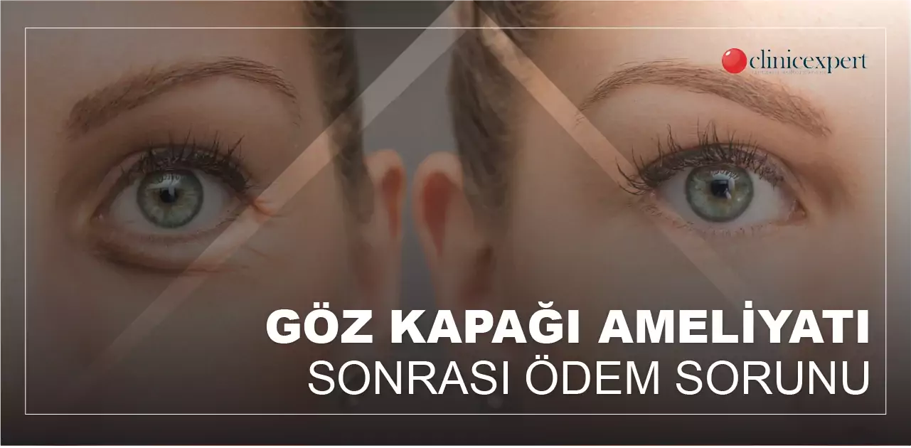 göz-kapağı-estetiği-sonrası-ödem