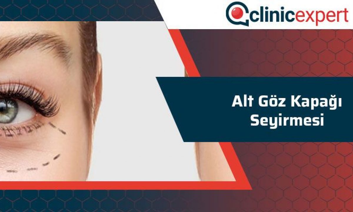 Alt Goz Kapagi Seyirmesi Clinicexpert Uluslararasi Saglik Hizmetleri