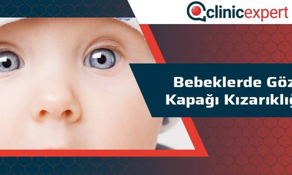 bebeklerde goz kapagi kizarikligi
