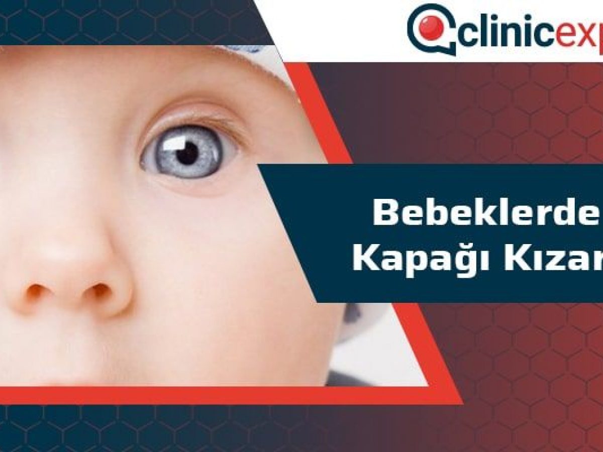 bebeklerde göz kayması kadınlar kulübü