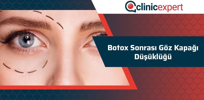 Botox Sonrası Göz Kapağı Düşüklüğü