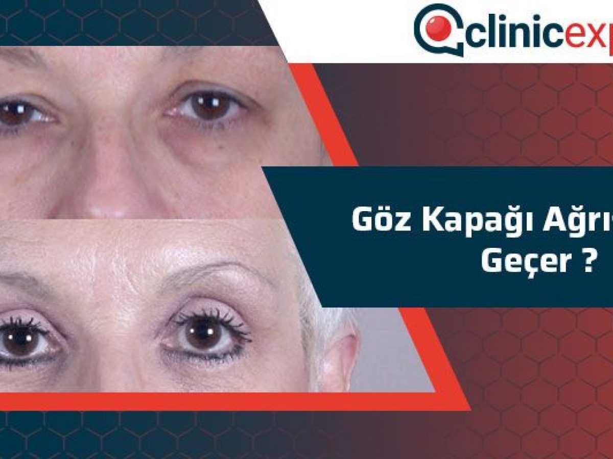 Goz Kapagi Agrisi Clinicexpert Estetik Merkezi