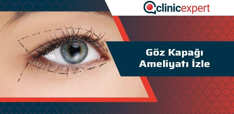 Göz Kapağı Ameliyatı İzle