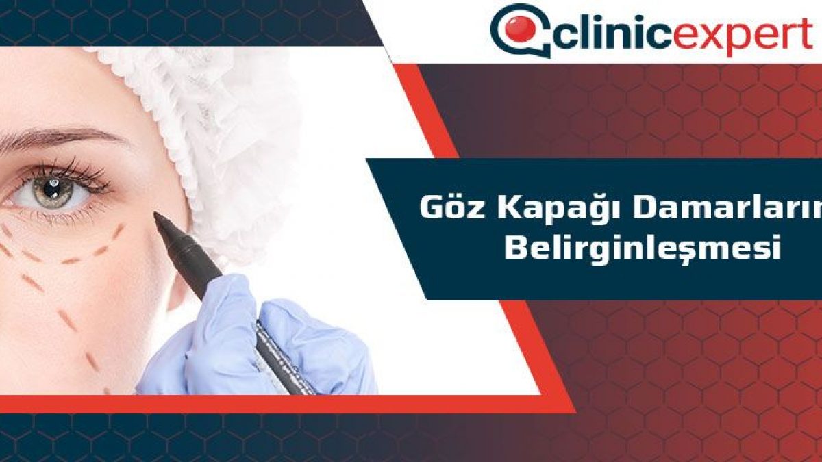 Goz Kapagi Damarlarinin Belirginlesmesi
