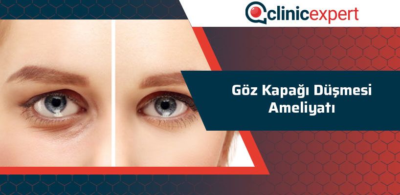 Göz Kapağı Düşmesi Ameliyatı