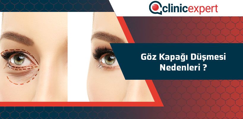 Göz Kapağı Düşmesi Nedenleri