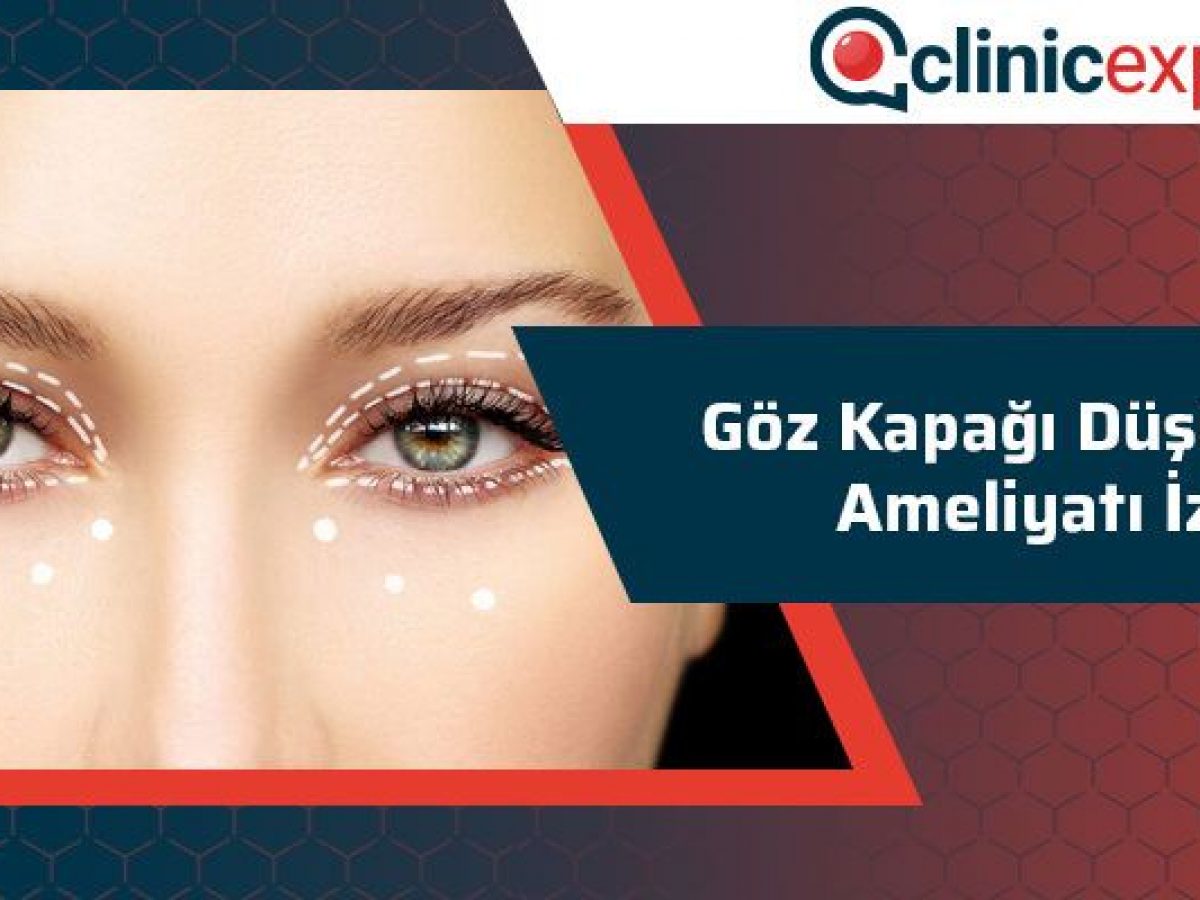 Goz Kapagi Dusuklugu Ameliyati Izle