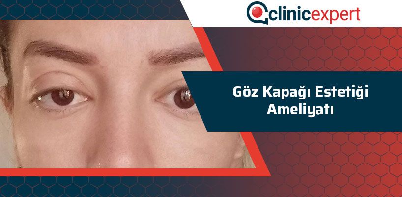 Göz Kapağı Estetiği Ameliyatı Nedir