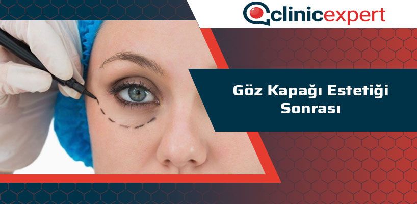 Göz Kapağı Estetiği Sonrası