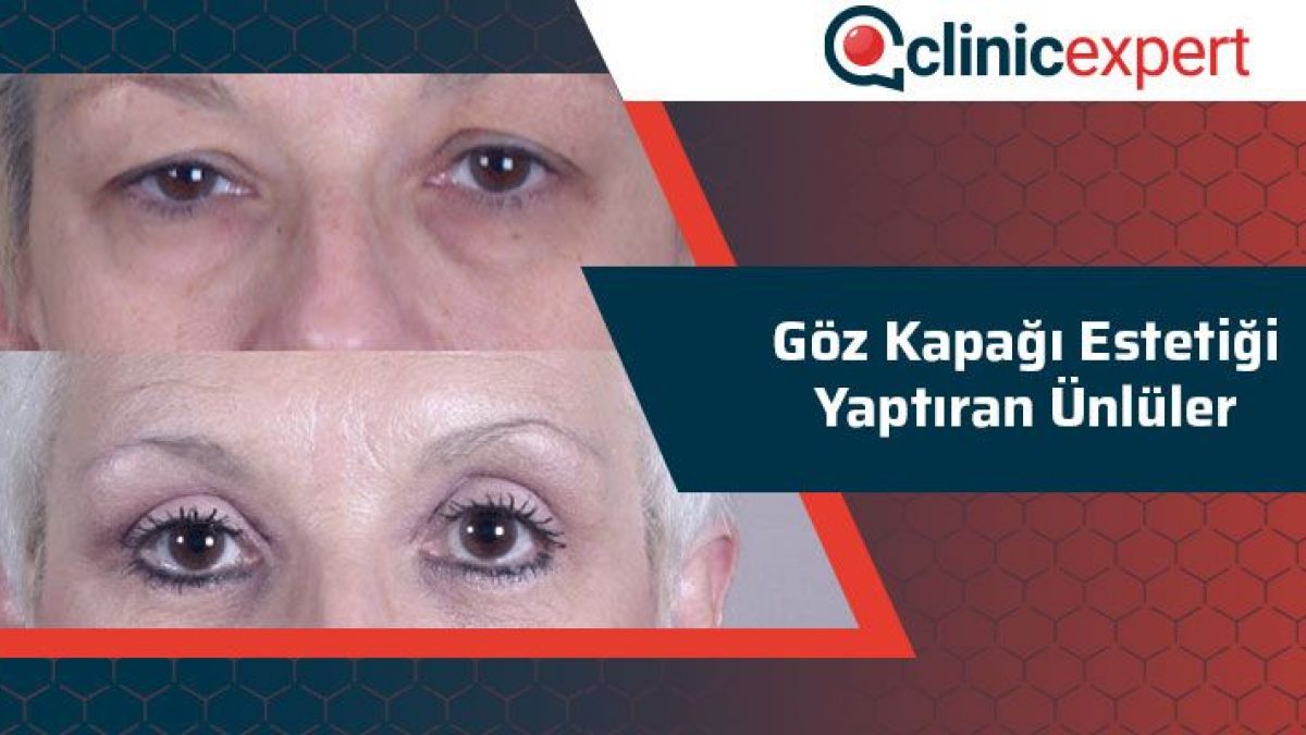 Goz Kapagi Estetigi Yaptiran Unluler