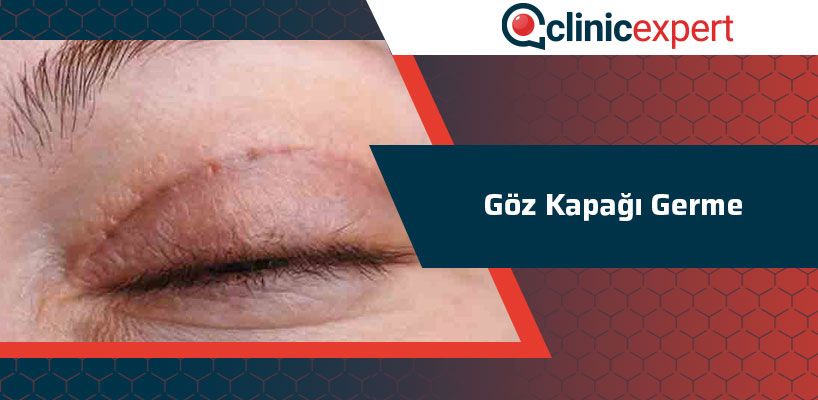 Göz Kapağı Germe