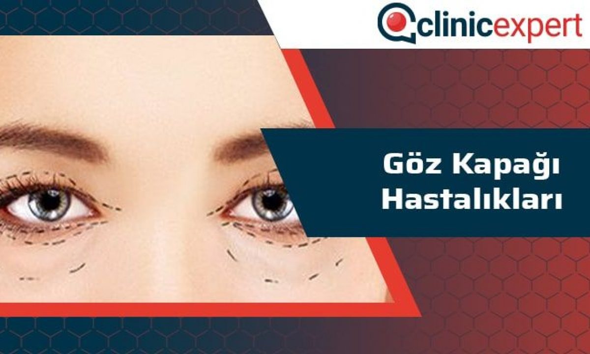 Goz Kapagi Hastaliklari Clinicexpert Uluslararasi Saglik Hizmetleri