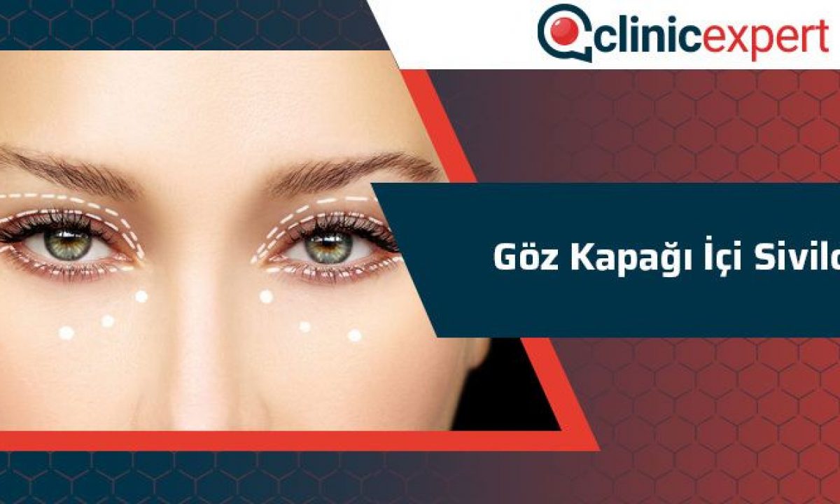 Goz Kapagi Ici Sivilce Clinicexpert Estetik Merkezi