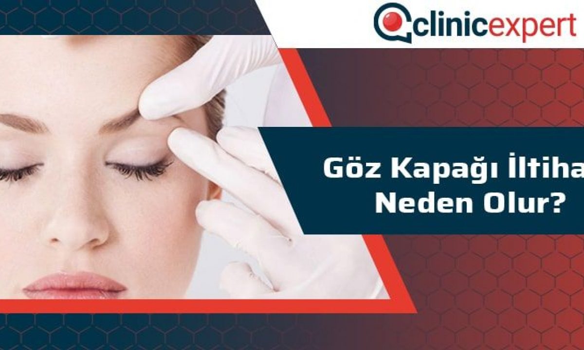 Goz Kapagi Iltihabi Neden Olur Goz Kapagi Iltihabi Neden Olur