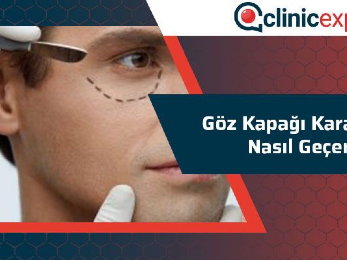 Goz Kapagi Kararmasi Nasil Gecer