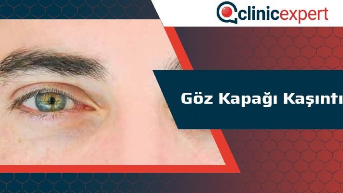 goz kapagi kasintisi clinicexpert uluslararasi saglik hizmetleri