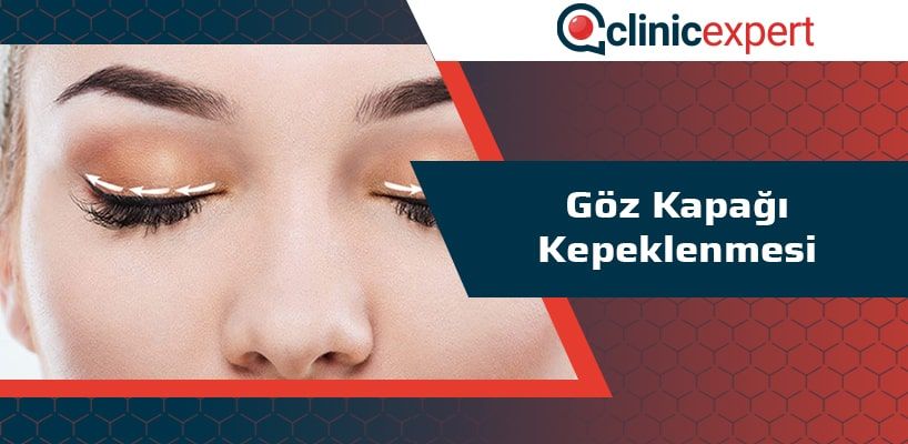 Goz Kapagi Kepeklenmesi Clinicexpert Uluslararasi Saglik Hizmetleri