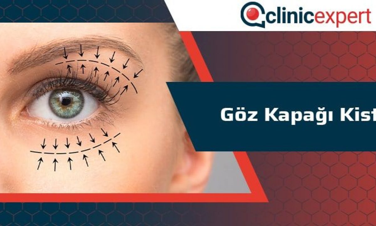 Goz Kapagi Kisti Clinicexpert Estetik Merkezi