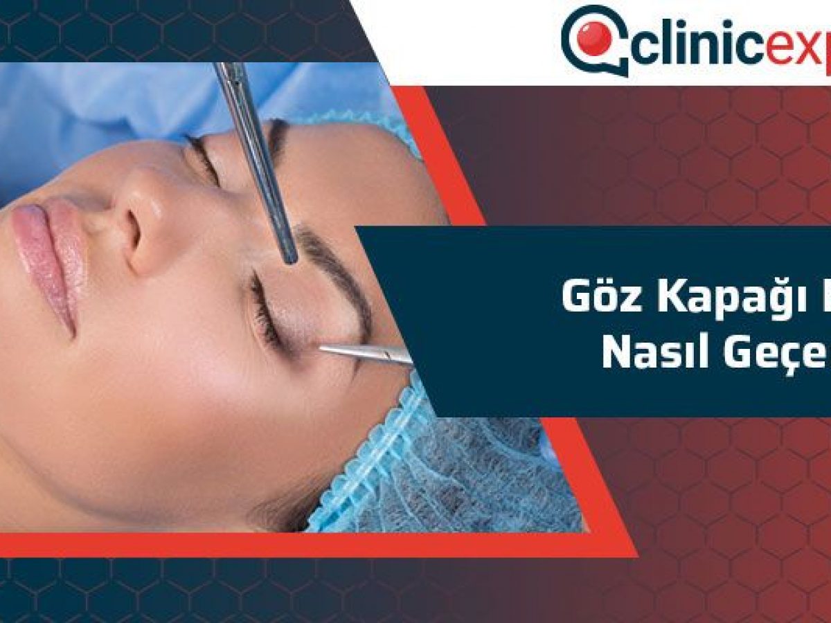 Göz Kapağı Kisti Nasıl Geçer