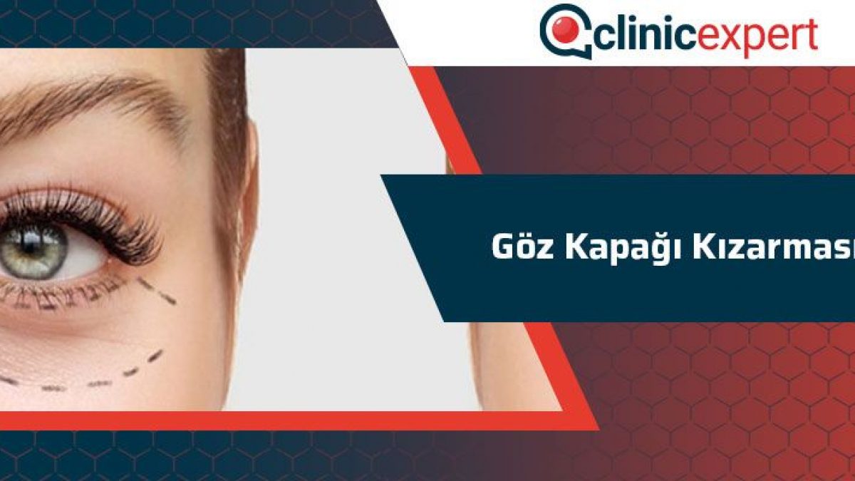 Goz Kapagi Kizarmasi Clinicexpert Uluslararasi Saglik Hizmetleri