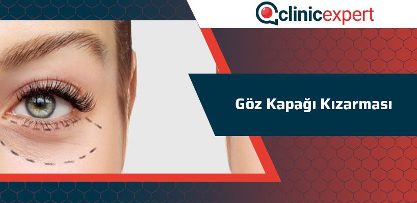 Goz Kapagi Kizarmasi Clinicexpert Uluslararasi Saglik Hizmetleri Goz Kapagi Kizarmasi Clinicexpert Uluslararasi Saglik Hizmetleri
