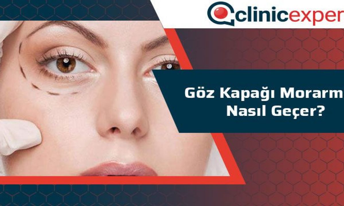 goz kapagi morarmasi nasil gecer