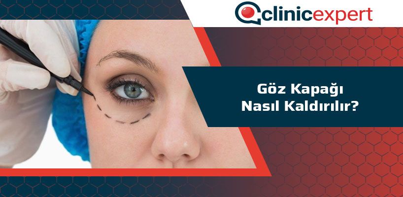 Göz Kapağı Nasıl Kaldırılır?