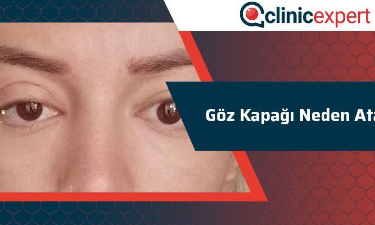 Goz Kapagi Neden Atar Clinicexpert Uluslararasi Saglik Hizmetleri