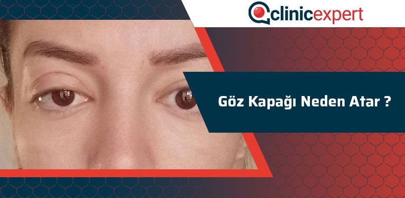 Goz Kapagi Neden Atar Clinicexpert Uluslararasi Saglik Hizmetleri Goz Kapagi Neden Atar Clinicexpert Uluslararasi Saglik Hizmetleri